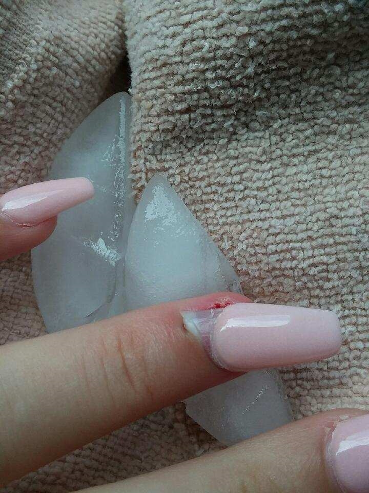 Hit my acrylic nail resulting in lifting my real nail and I believe pushing  the nail bed to skin | Nail Disorders | Forums | Patient