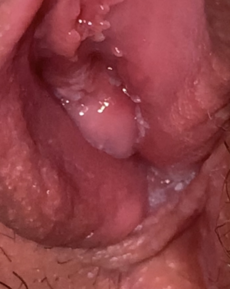 Difference between vestibular papillomatosis and genital warts