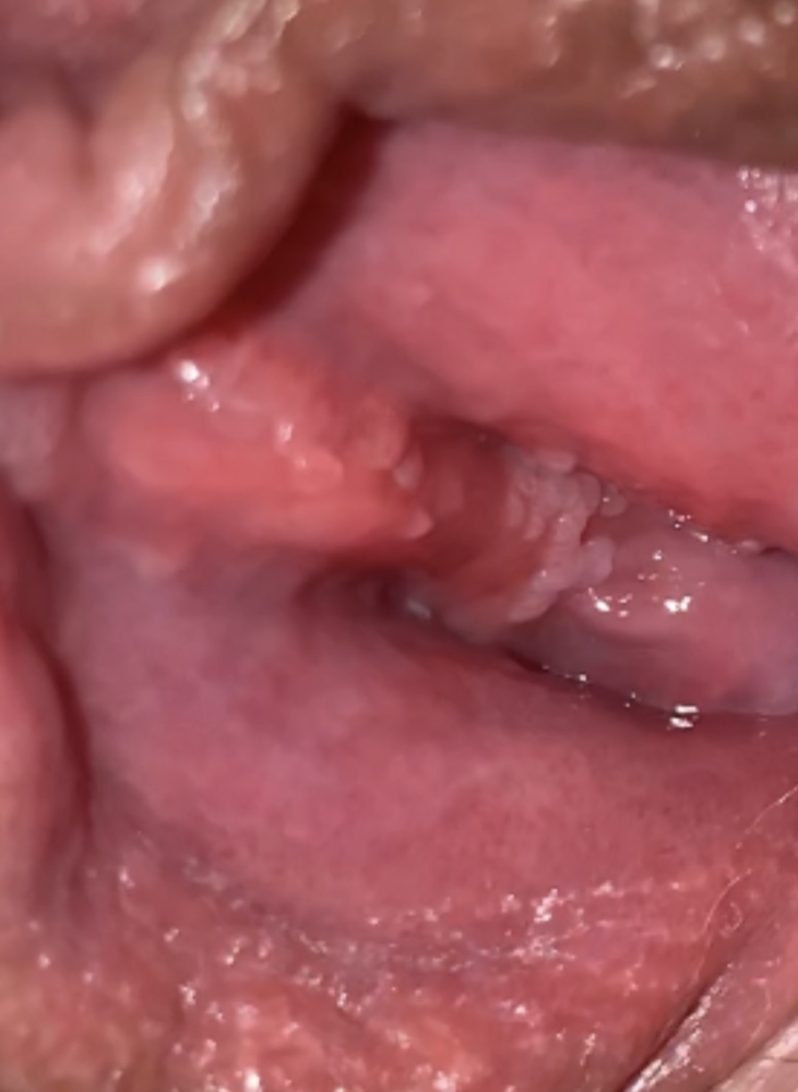 Vestibular papillomatosis or herpes