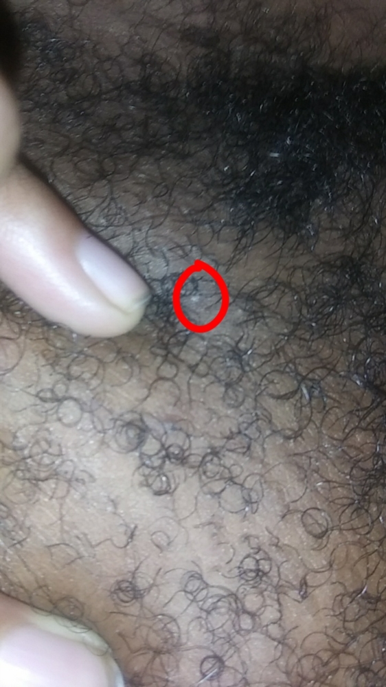 red bump on scrotum