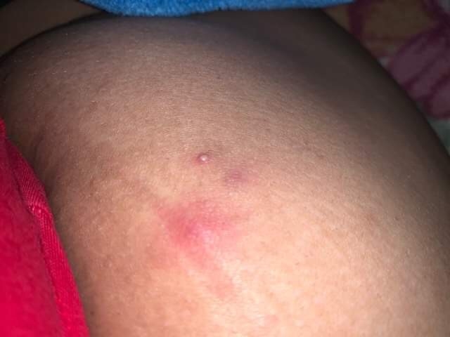 Hurts butt on to my sit pimple Buttocks Breakouts: