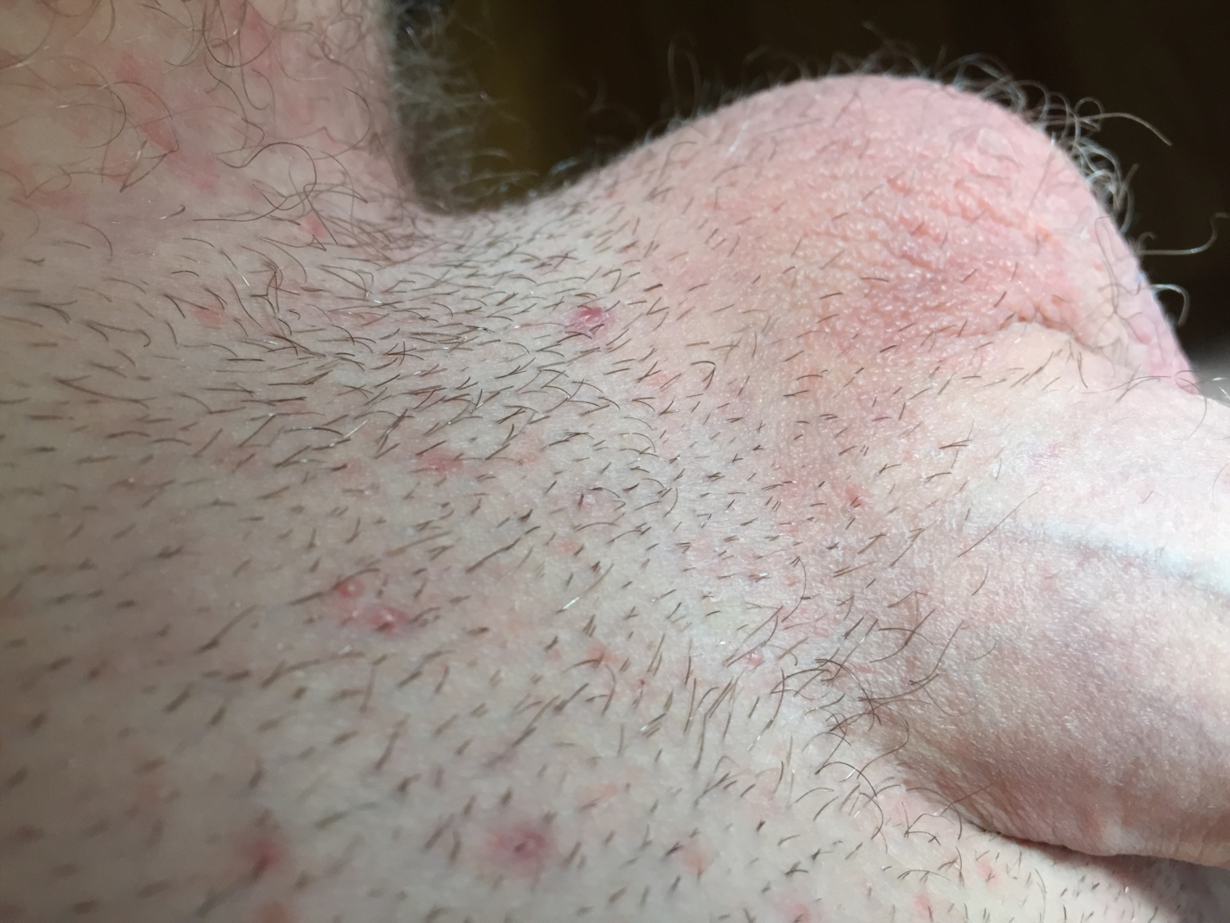 Help No Clue What These Small And Big Bumps Are Genital Herpes Simplex