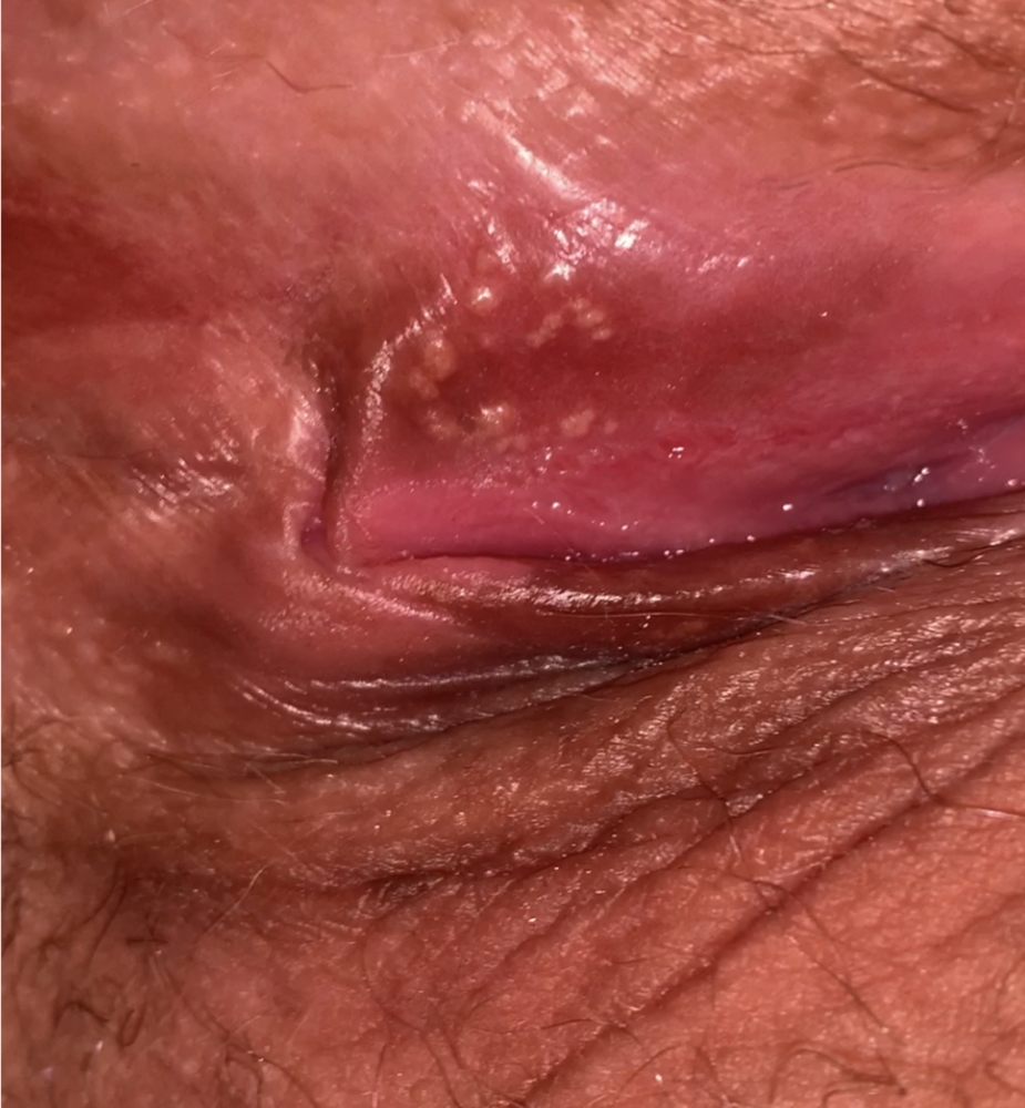 Lump On Vagina
