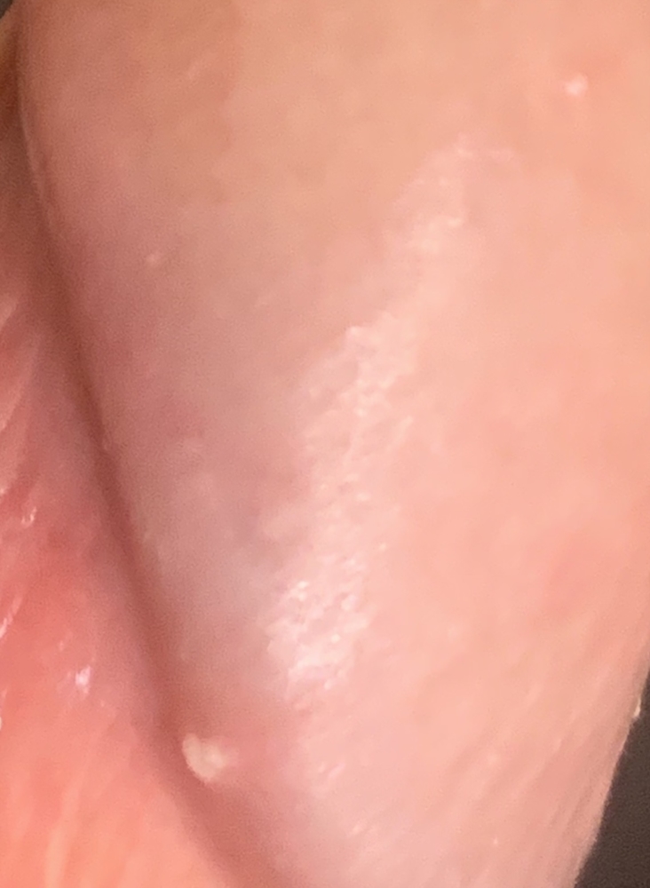 On penis pimples white Common cause
