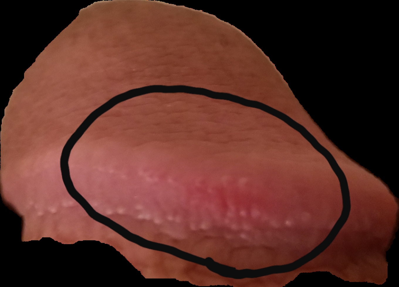 Found A Bit Of Redness In This Area Of The Tip Should I Worry Penis