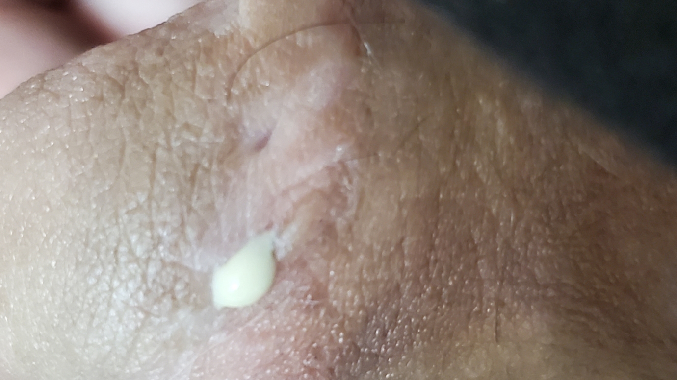 is this smegma? im circumsized but this has a bad odor and is coming out fr...