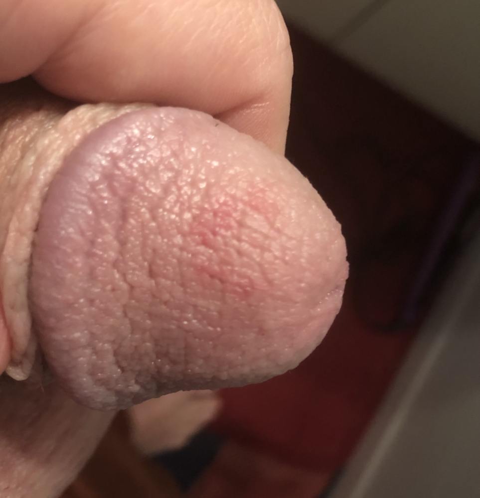 Bumps Around The Head Of A Penis