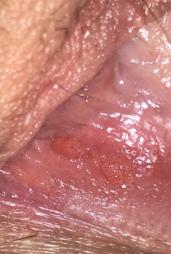 Causes of red and itchy vaginal pimples