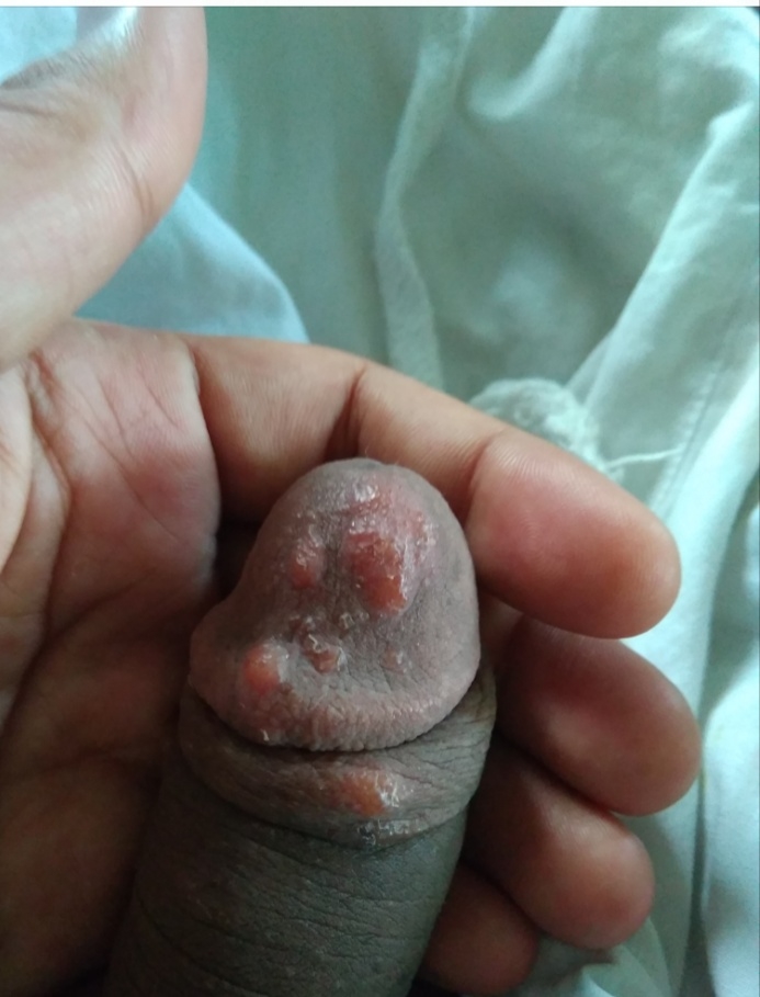 This is the image of my pimple on penis head, its been a week , there is it...