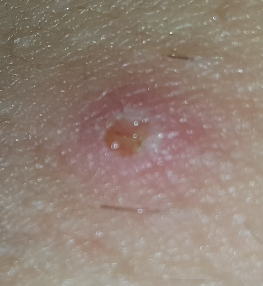 Infected/ingrown hairs or herpes..? | Sexual Health | Forums | Patient