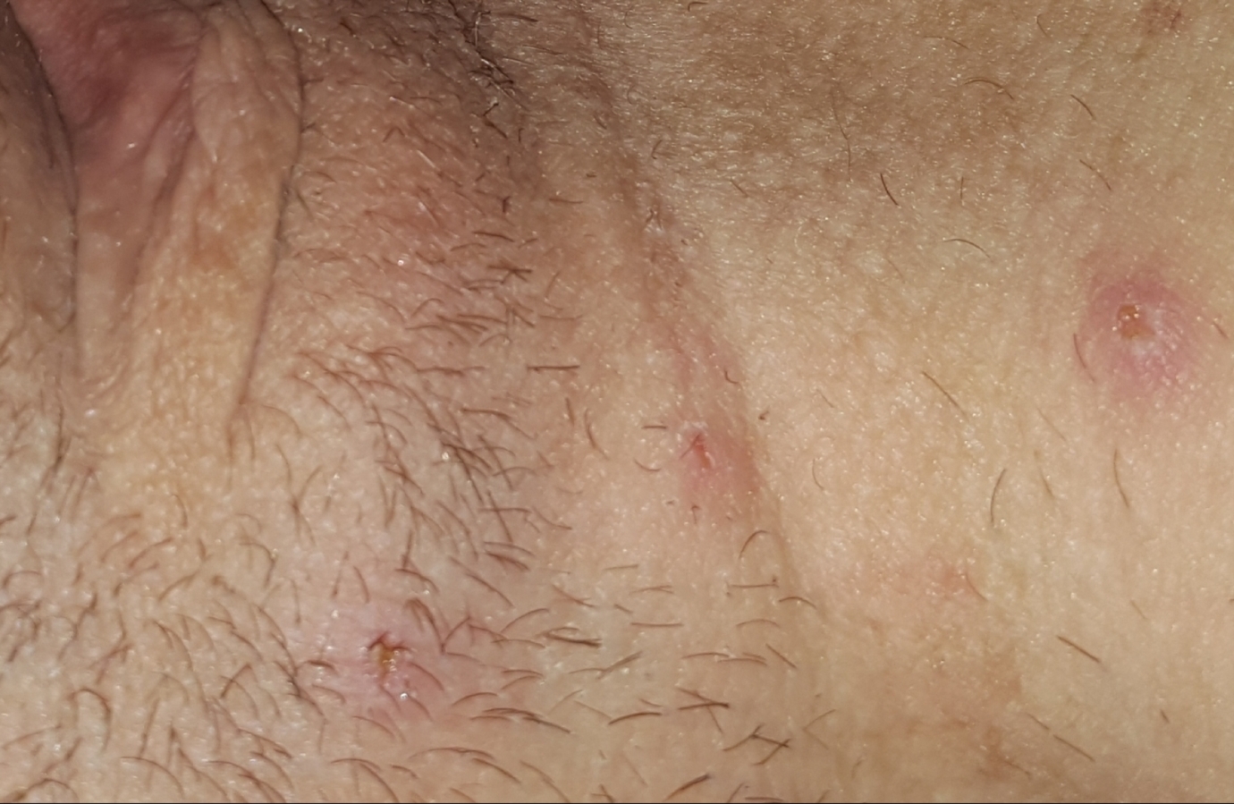 Infected/ingrown hairs or herpes..? | Sexual Health | Forums | Patient