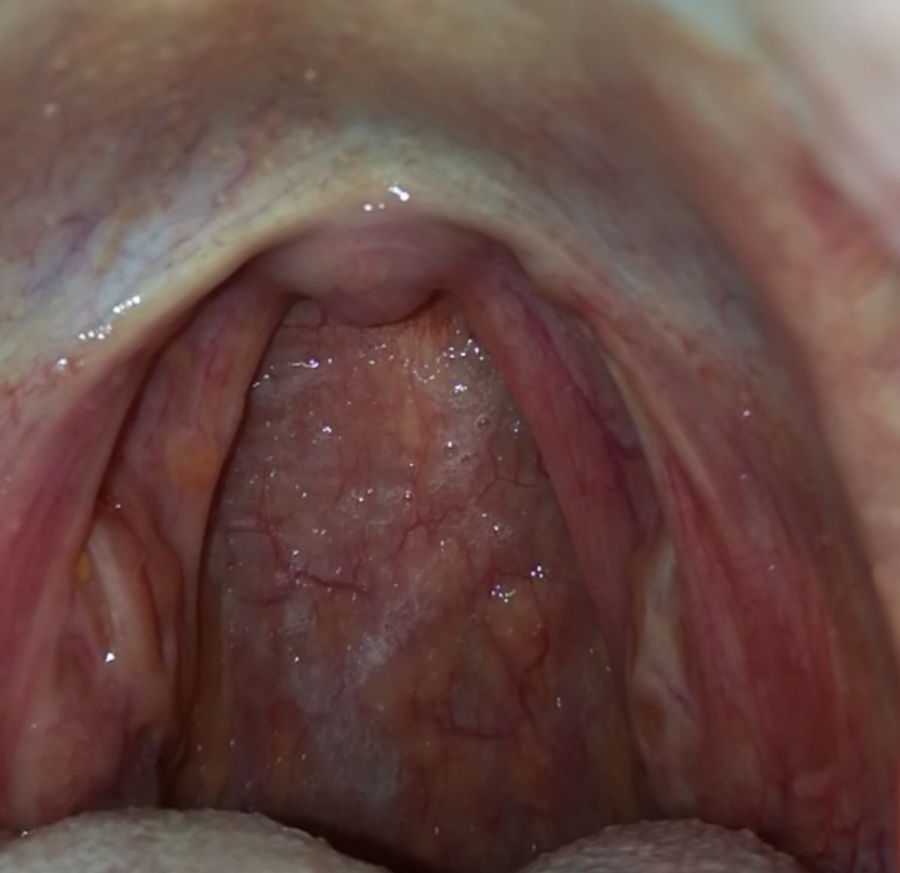From sex tonsillitis oral Case Report: