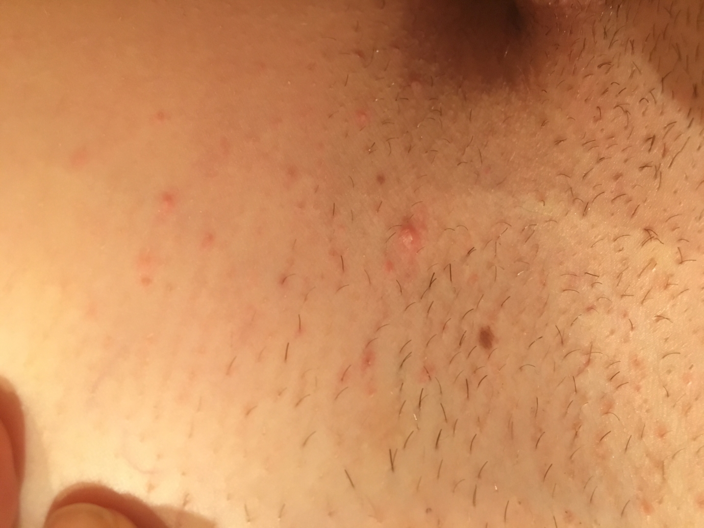 Bumps herpes razor Skin Rash