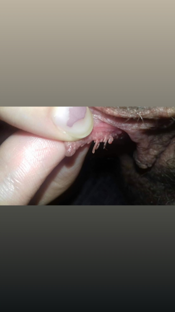 Vestibular papillomatosis symptoms - chemiclean.ro - Squamous vestibular papillomatosis treatment