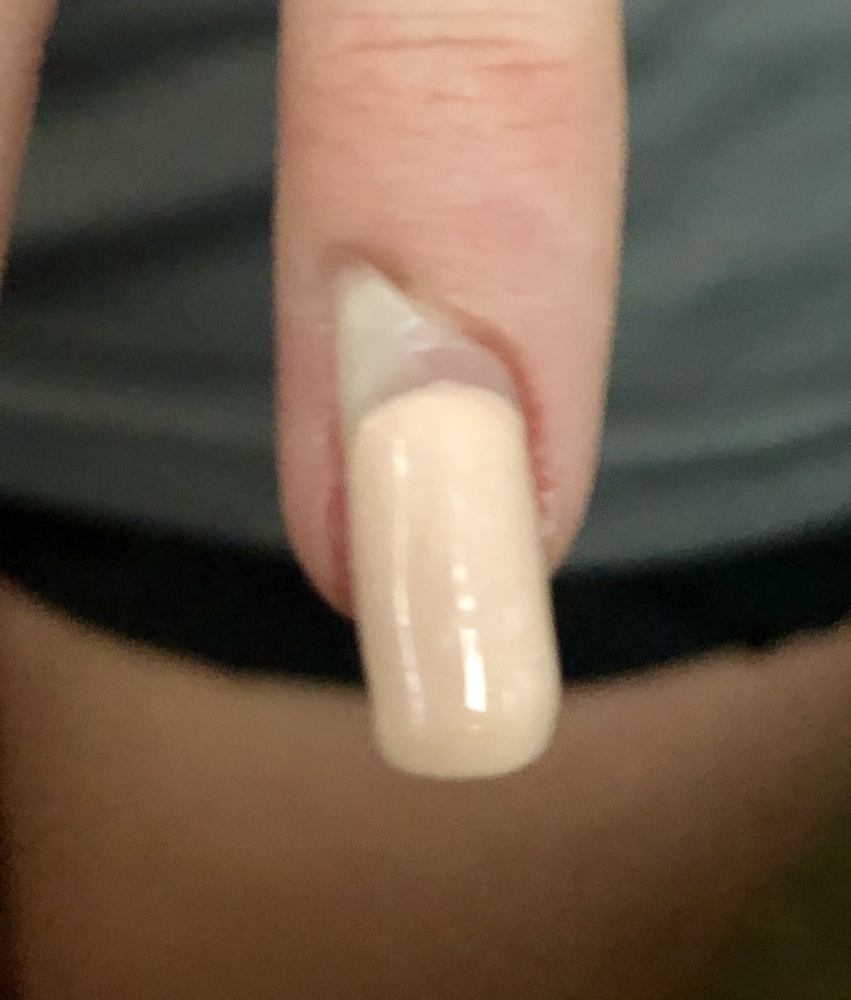 Hit My Acrylic Nail Resulting In Lifting My Real Nail And I Believe Pushing The Nail Bed To Skin Nail Disorders Forums Patient