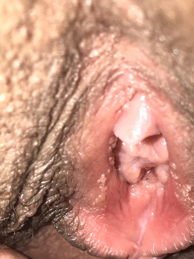Its possible to have warts in or around the anus and not be aware of them. 