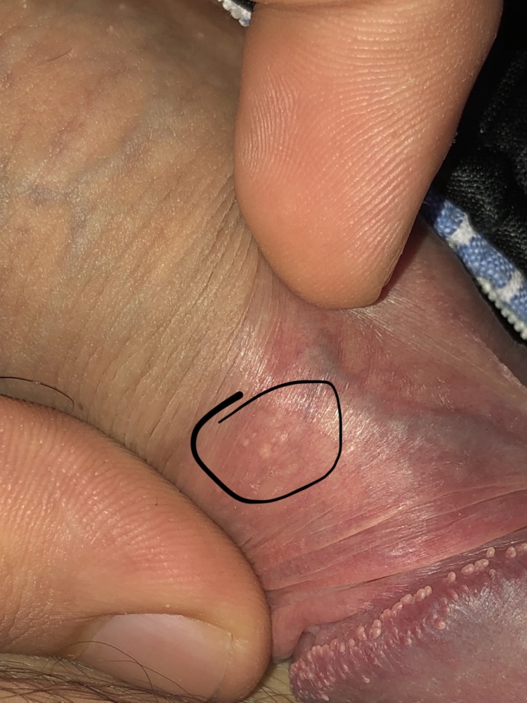 Noticed This On My Penis Could It Be Herpes Sexual Health Forums Patient