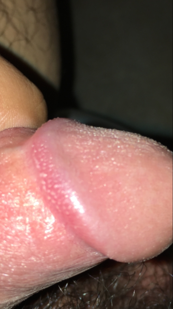 White penis bumps