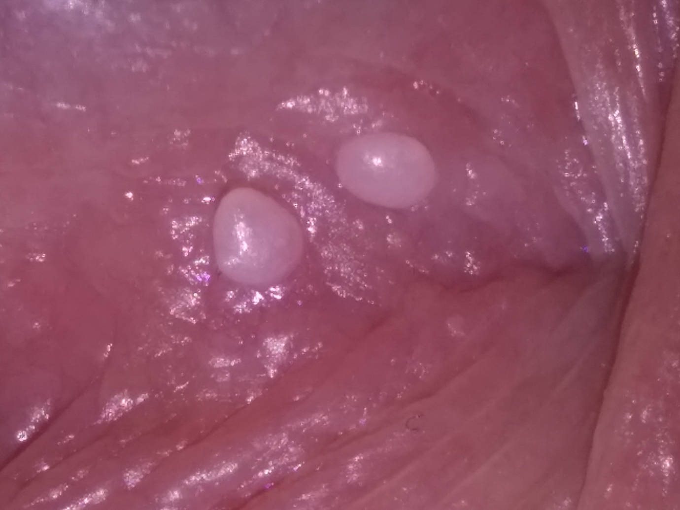 small white spots on penile shaft - www.optuseducation.com.