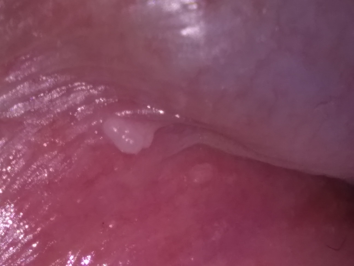White bumps around penile shaft
