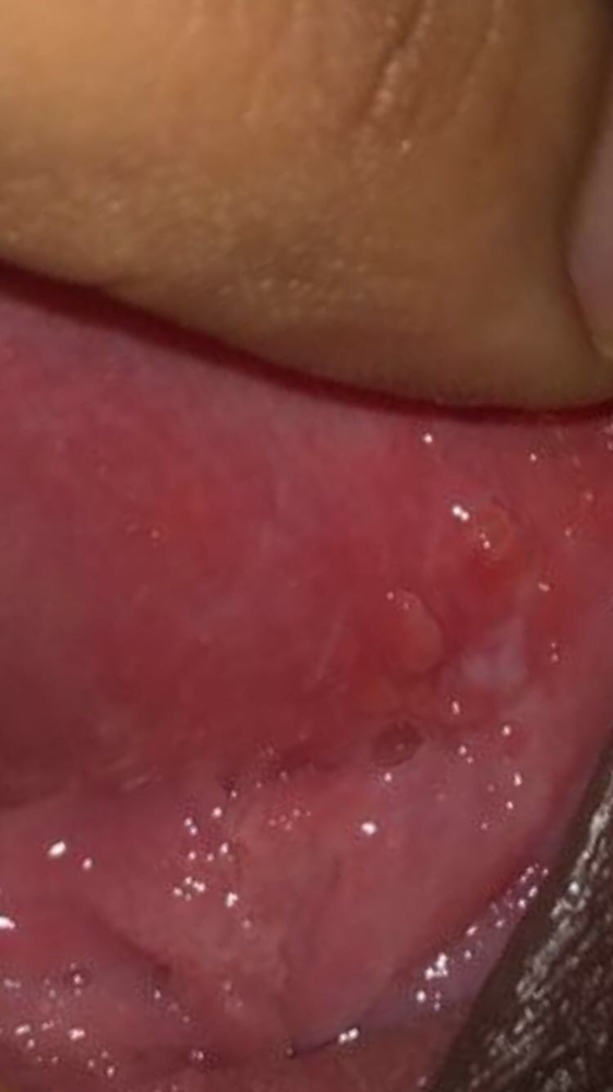 Are These Warts Warts And Verrucas Forums Patient