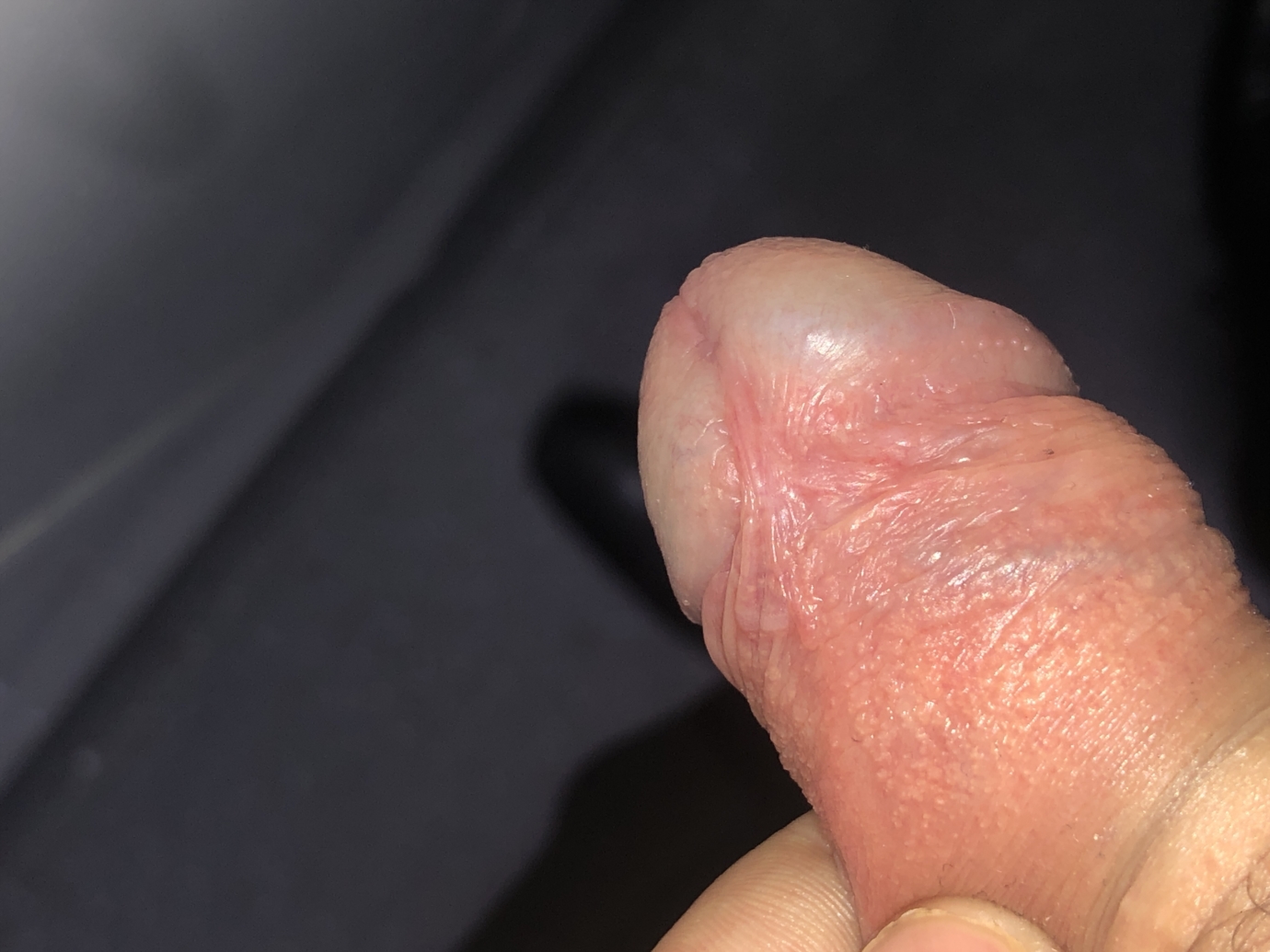 Small white blisters on penis