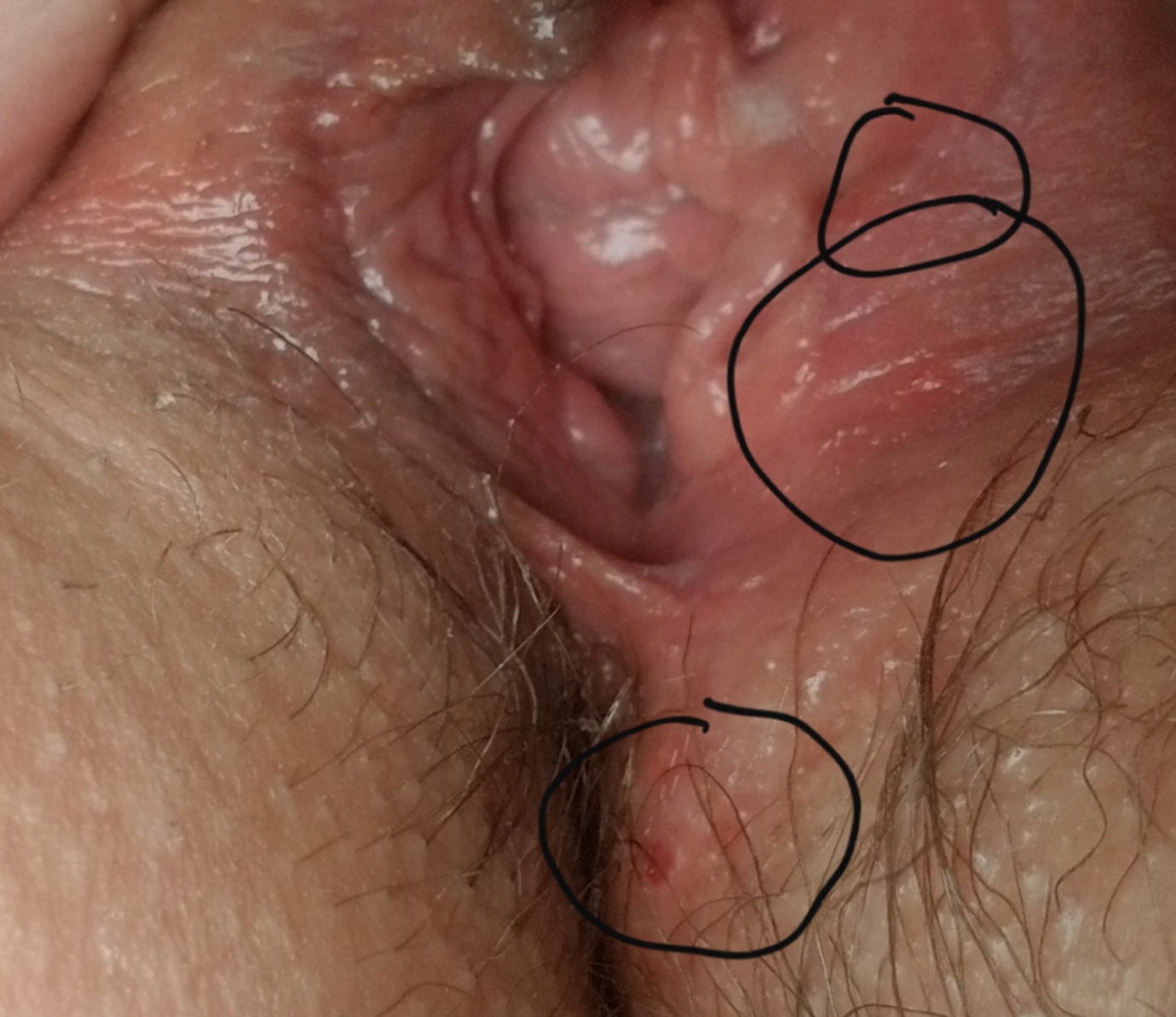HELP, HELP Yeast infection, herpes, Vaginitis? 
