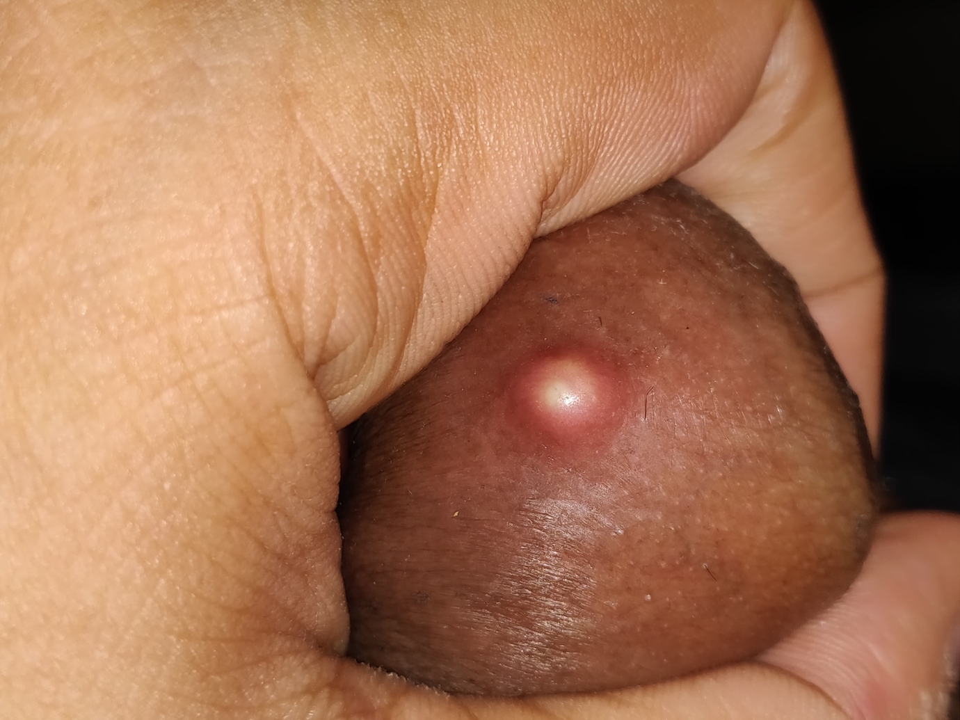 My dick on pimple Whiteheads on