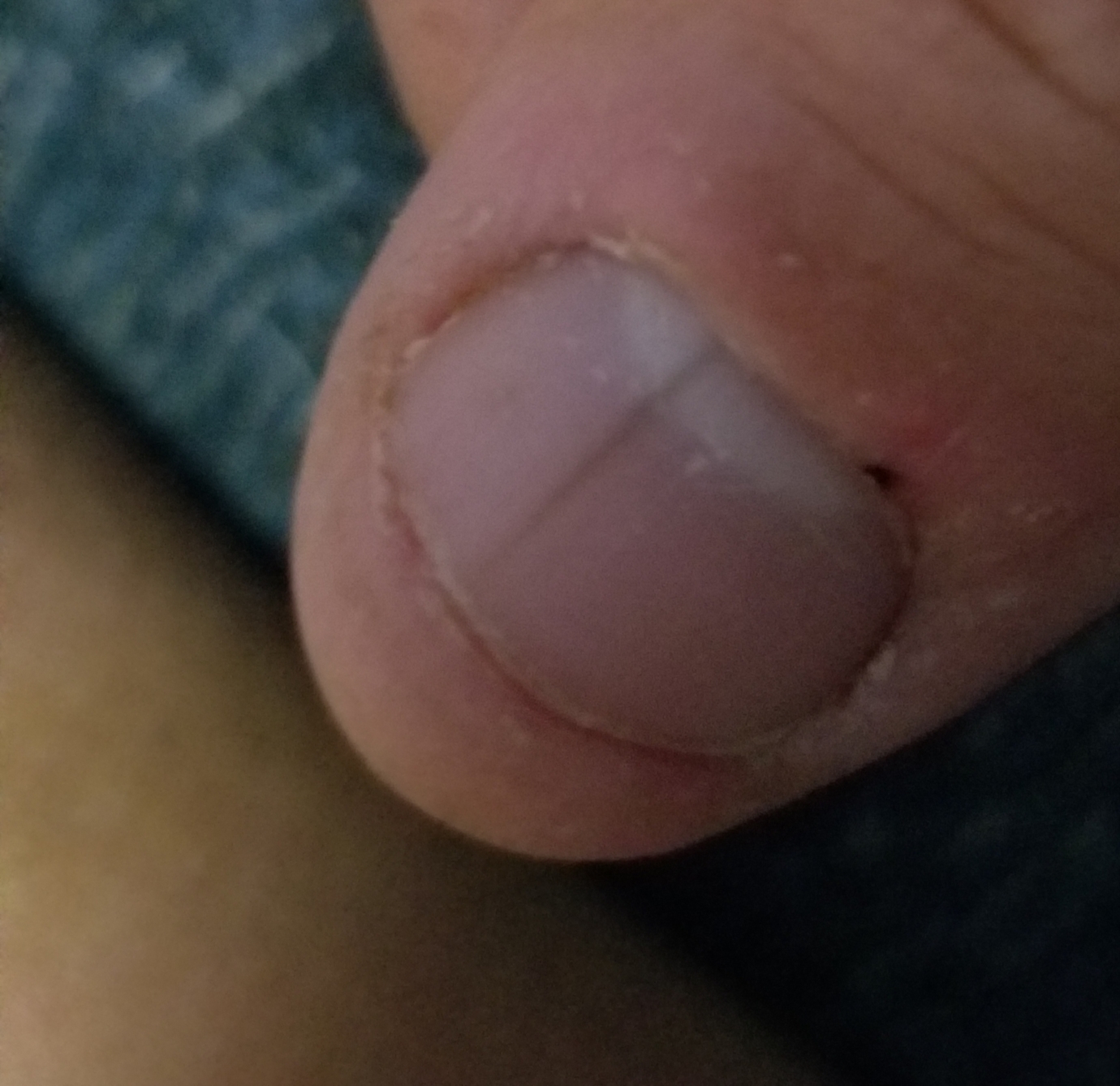 Thin black line on thumb nail... ideas? | Nail Disorders | Forums | Patient