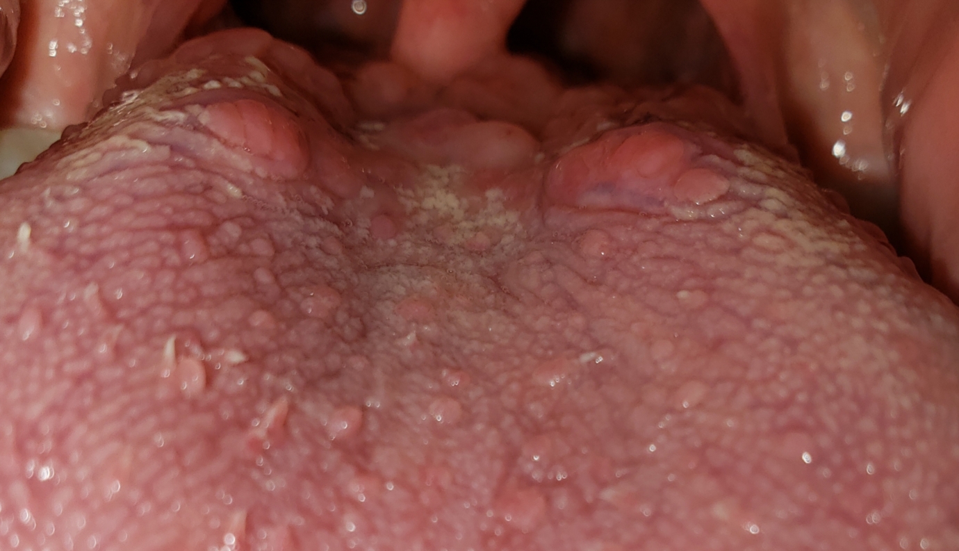 sy Kurve TRUE Weird bumps on back of tongue white film | Oral and Dental Problems |  Forums | Patient