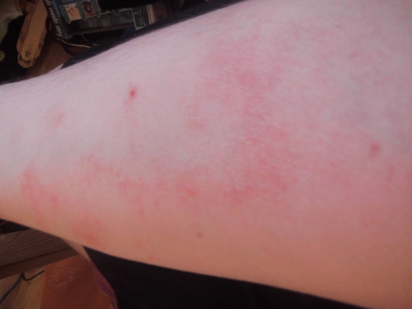 Unexplained Red Rashes All Over Body Other Conditions And General