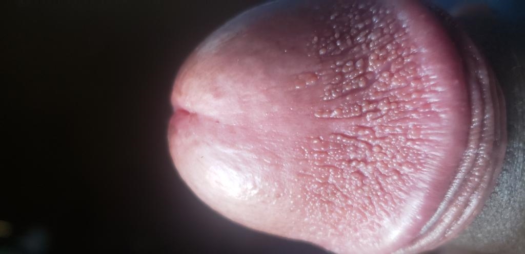 On pink shaft bumps penile Pink bumps