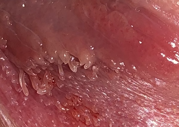papillomatosis vestibular papilloma on the lip