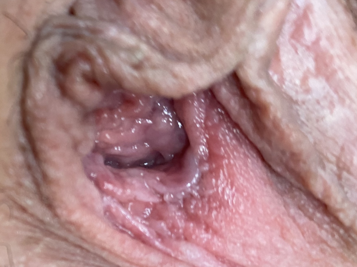Vestibular papillomatosis dangerous. Why is the papillomavirus dangerous