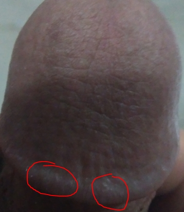 I have this white bumps for 1.5 months, i am 18 years old and i didnt sex i...
