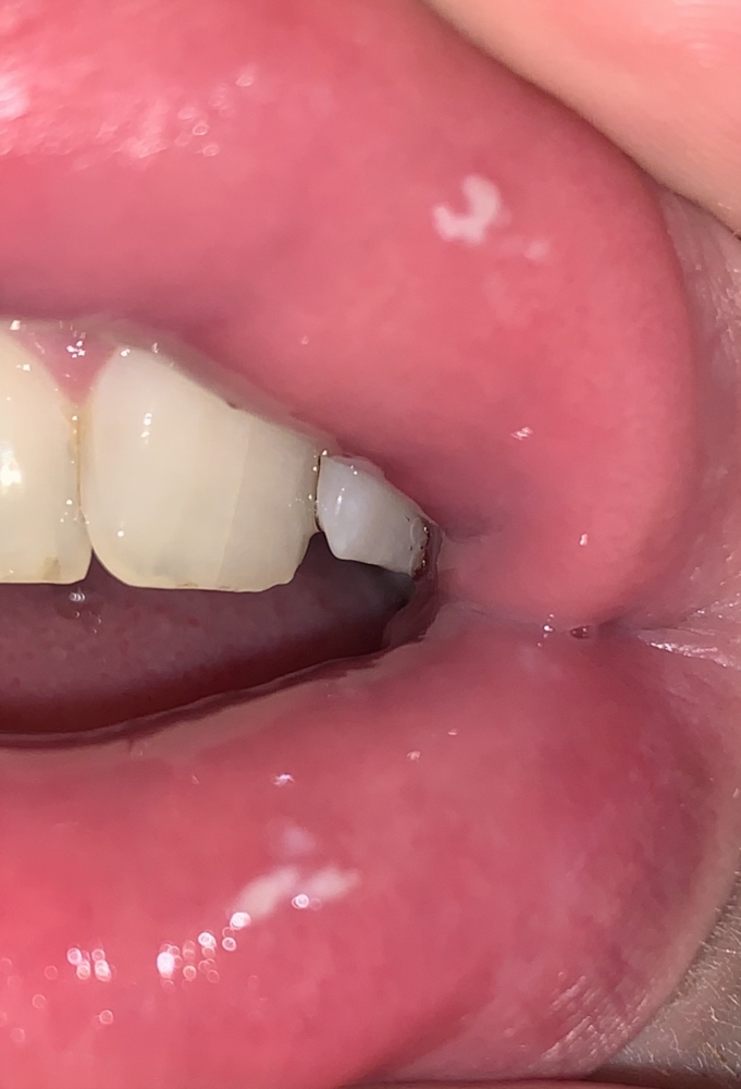 papilloma mouth sore
