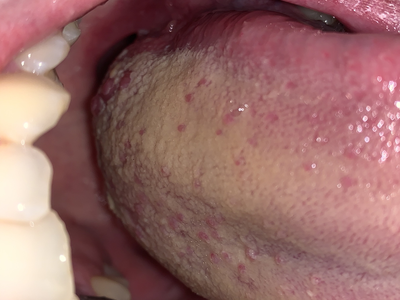 Benign wart on tongue, Wart on the tongue