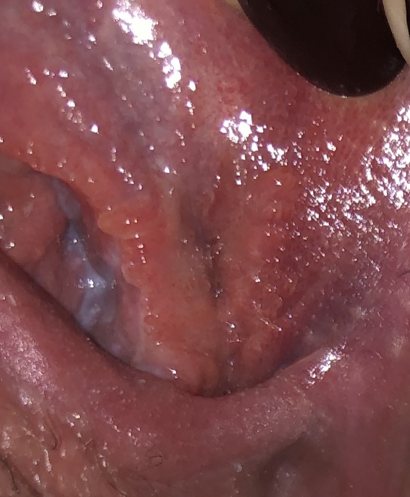 Does hpv virus cause cold sores