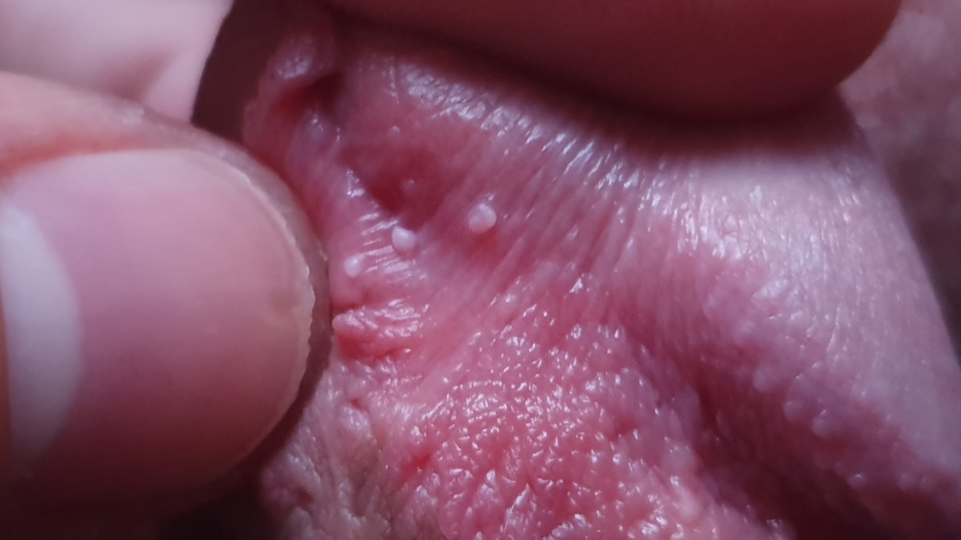 White bumps/spots under glans Penis Disorders Forums Patient. 