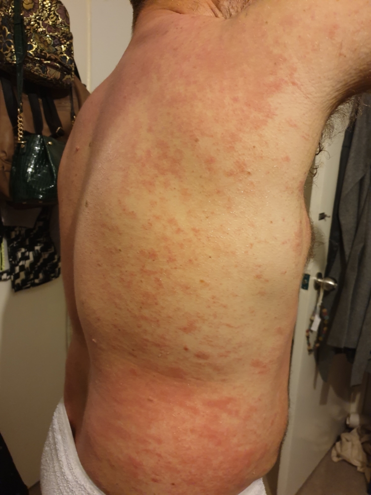 Red Rash All Over My Body Which Tingles And Bumpy Pictures Dermatology Forums Patient