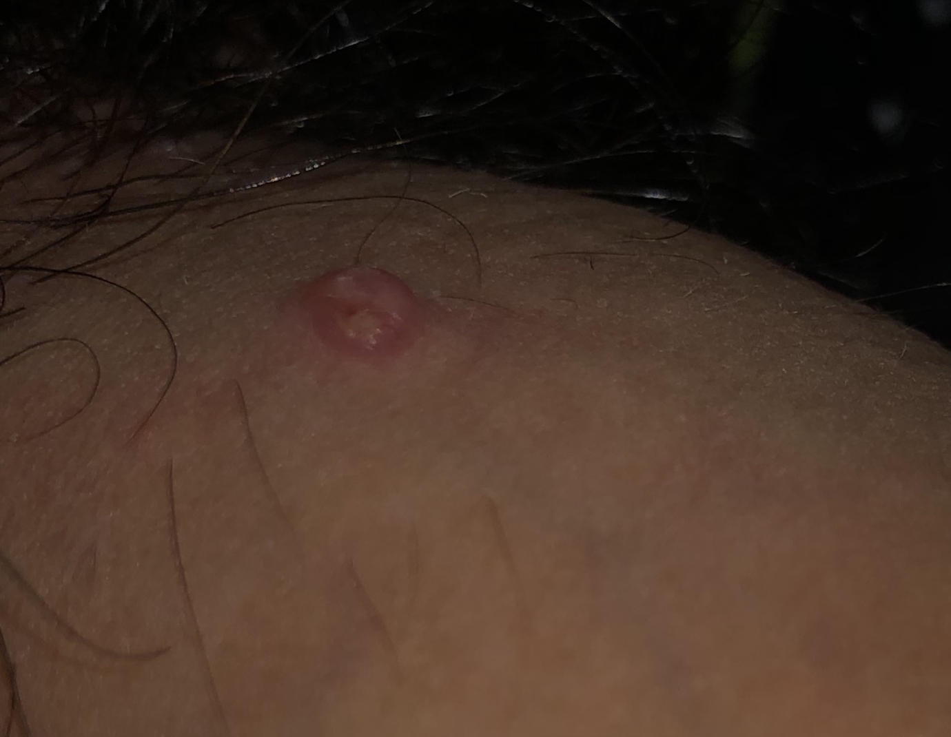 Pimple on cock