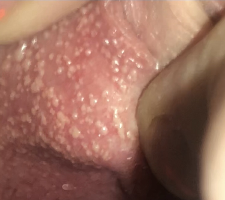 fordyce spots on tongue