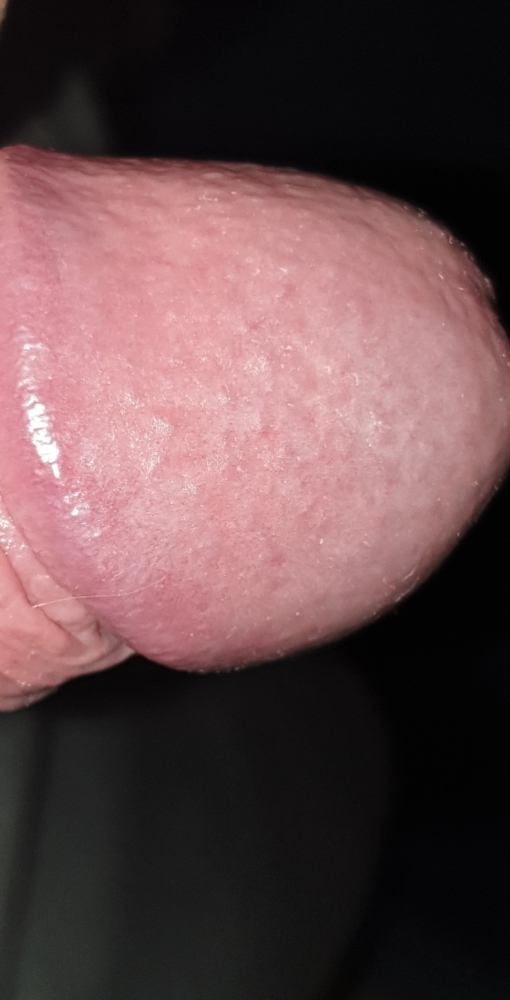 Penis bumps on Scaly Penis