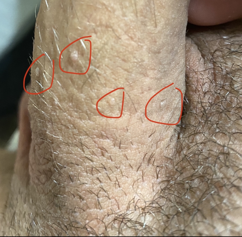 Odd bump/s appeared. Worried it’s GW | Penis Disorders | Forums | Patient