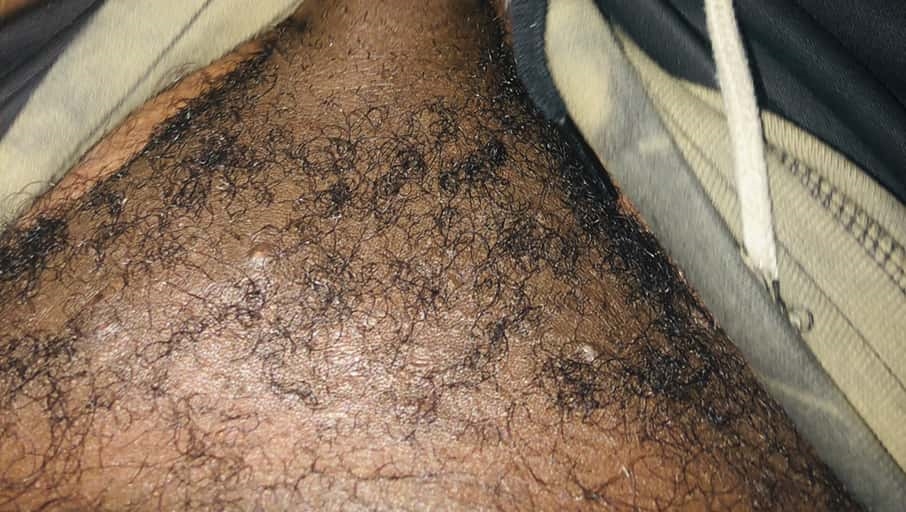 Is this herpes, if not what is it? | Genital Herpes Simplex | Forums