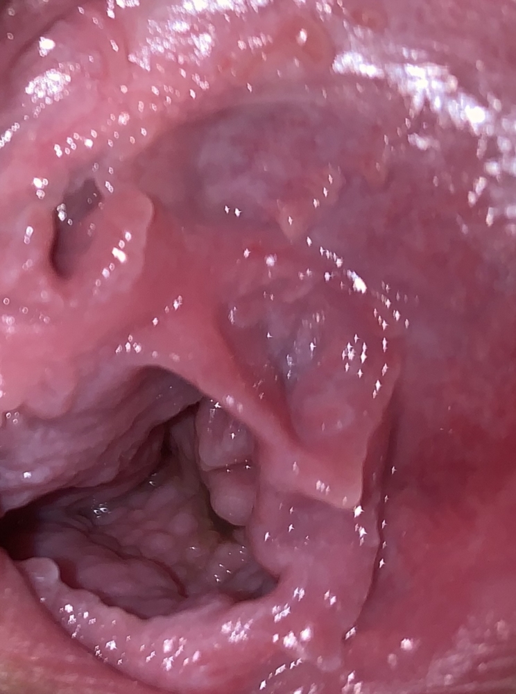 Swollen Vagina Or Vulva