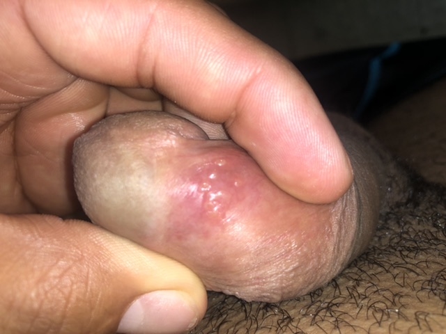 Can somebody tell me what this is?!!!! Im scared Penis Disord image