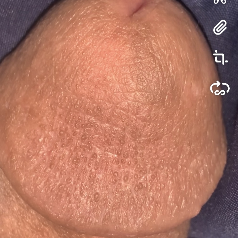 Head pimples on penile Penile Bumps