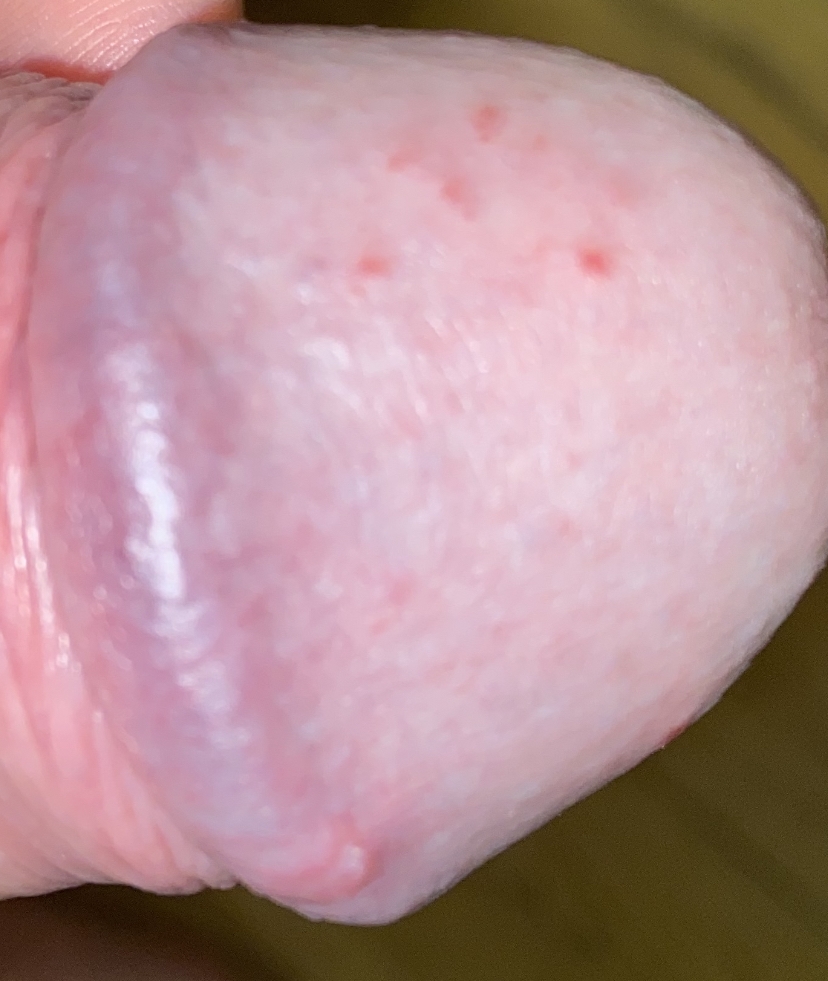 red dots, and one painless bump penis gland | Penis Disorders | |