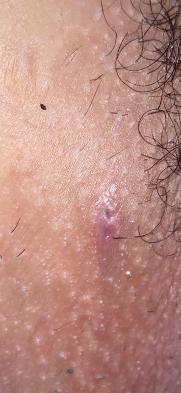 Is This An Ingrown Hair Or A Herpes Outbreak Genital Herpes Simplex Forums Patient